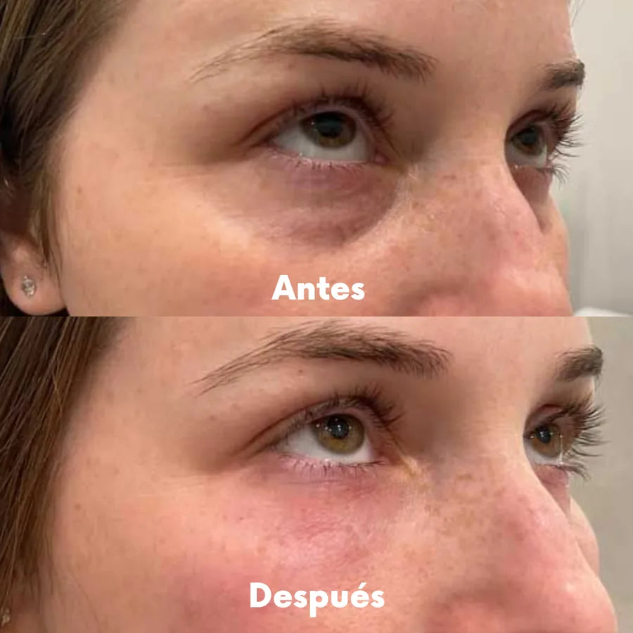 Redermis - Gafas Luz Roja Anti Ojeras y Bolsas - g02_antes_1