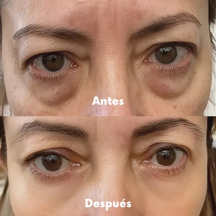 Redermis - Gafas Luz Roja Anti Ojeras y Bolsas - g04_antes_2